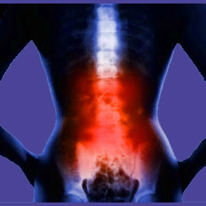 Causes of Lower Back Pain