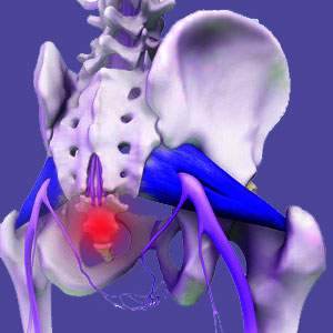 Coccyx pain