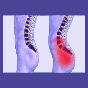 Idiopathic Lower Back Pain