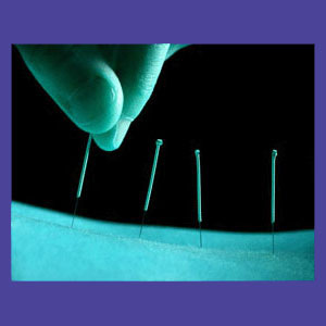 Lower Back Pain Acupuncture