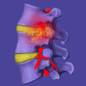 Lumbar chemical radiculitis