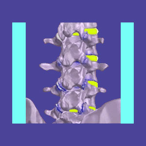 lumbar facet joint syndrome