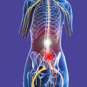 Lumbar foraminal stenosis