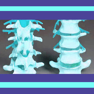 lumbar spinal discs