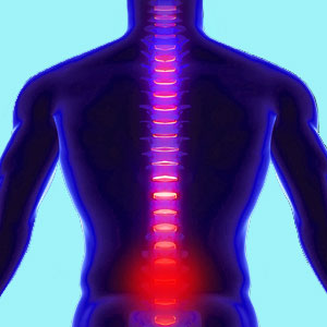 Lumbar Spinal Syrinx