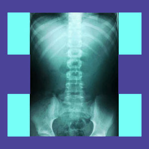 Lumbar spine x-ray