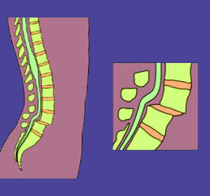 Lumbar spondylolisthesis