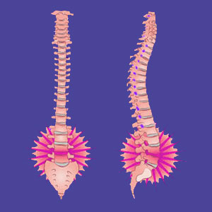 Mechanical Lower Back Pain