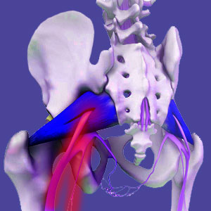 Piriformis syndrome