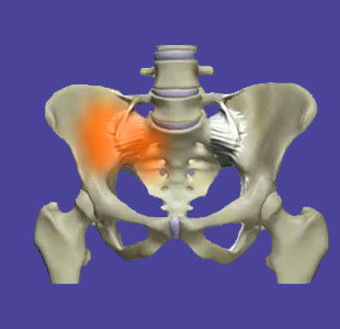 Sacroiliac pain